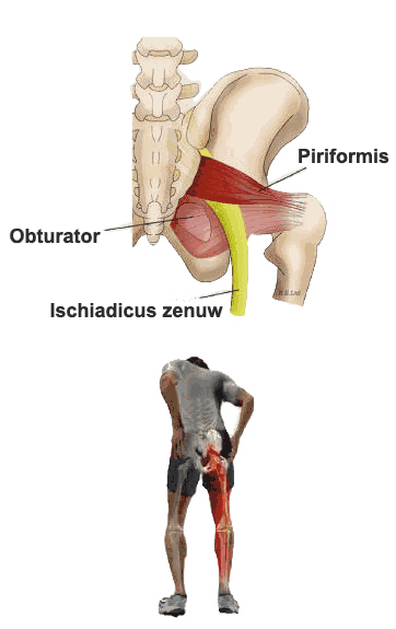 Piriformis syndrome